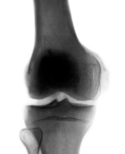 Рентгенограмма коленного сустава (прямая проекция) при болезни Пеллегрини — Штиды: <a href=