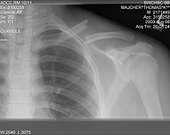 Clavicle fracture left.jpg