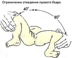 Congenital dislocation of the hip 3.jpg
