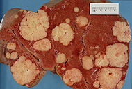 Secondary tumor deposits in the liver from a primary cancer of the pancreas.jpg